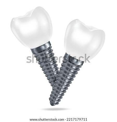 Vector 3d realistic rendering of white dental implant dentures closeup isolated on white background. Dentistry, medicine and healthcare concept. Prosthesis design template. Foreground.