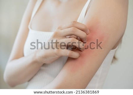 Dermatology, asian young woman, girl allergy, allergic reaction from atopic, insect bites on her arm, hand in scratching itchy, itch red spot or rash of skin. Healthcare, treatment of beauty. Сток-фото © 