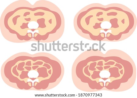 Obesity type: Subcutaneous fat and visceral fat