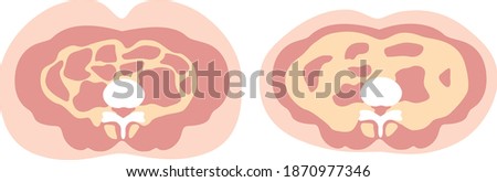 Obesity type: Subcutaneous fat and visceral fat