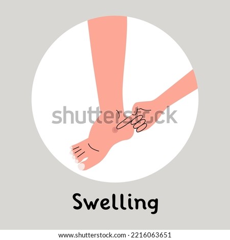 Swelling of the feet, edema. By pressing a finger a dent appers. Flat vector illustration.