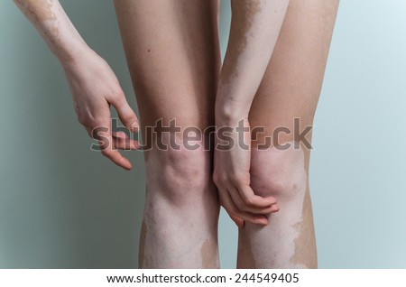 vitiligo female limbs arms, hands and knees