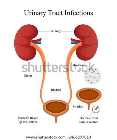 Urinary Tract Infection (UTI) Diagram Design for Medical