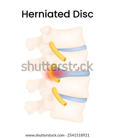 Disc Herniation Symptoms and Causes