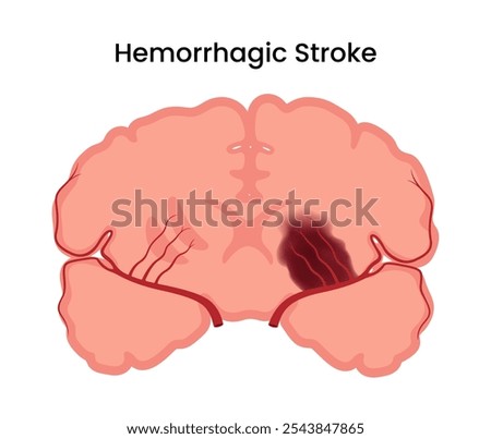 Symptoms and Causes of Hemorrhagic Stroke