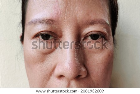 close up the sagging skin under the eyes, wrinkle skin problem on the face, gloomy eyes. 