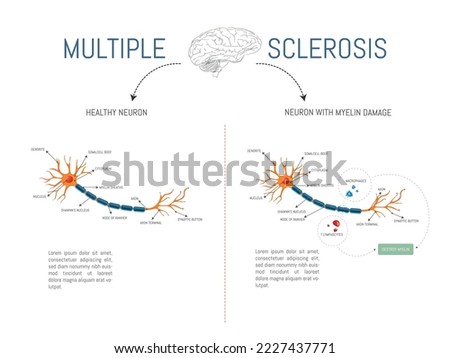 Infographic of a healthy neuron and one with damage from attack by myelin-destroying lymphocytes and macrophages in multiple sclerosis disease.