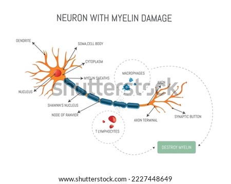 Infographic of a neuron damaged by lymphocyte and macrophage attack that destroys myelin in multiple sclerosis disease.