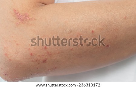 Allergic skin lesions on the arms Thailand Asian women.