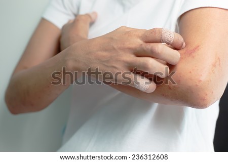 Sores from scratching allergy to arm women.