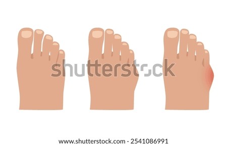 Taylor deformation. Valgus deformity of the little toe joint. Vector illustration.