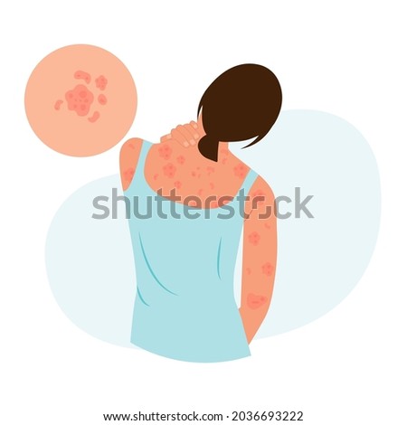 The woman is scratching her back. Allergic itching, skin inflammation, redness and irritation.Guttate psoriasis.Atopic dermatitis, eczema, psoriasis, dry skin. Skin problems.isolated, vector.