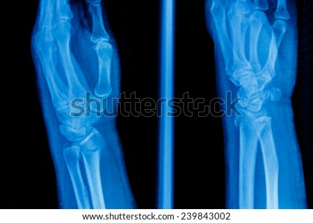Film x-ray showing broken of wrist bone