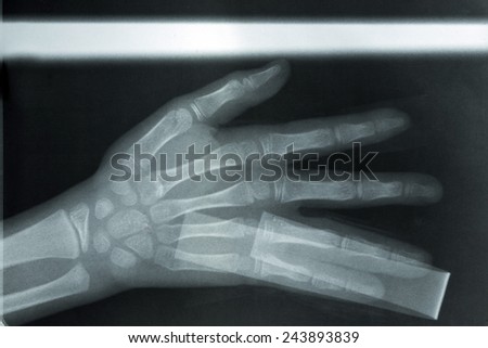 film x-ray image show broken of finger bone with aluminum plate fixation