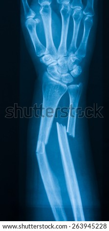X-ray image of broken forearm, AP view, show fracture of ulna and radius bone