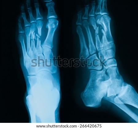 X-ray image of foot, AP and oblique view, show fracture of the second and third metatarsal