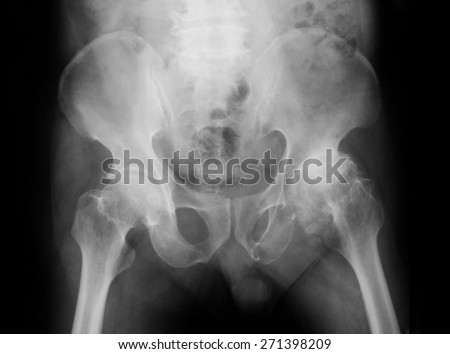 X-ray pelvis with both hip joints , AP view, show left hip osteoarthritis (Degenerative arthritis of the hip)