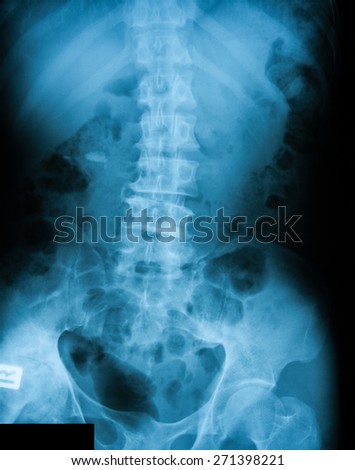 X- ray image of plain KUB (Kidney, Ureter, Bladder ), Show right kidney stones.