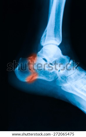 X-ray image of ankle, lateral view, show calcaneus fracture.