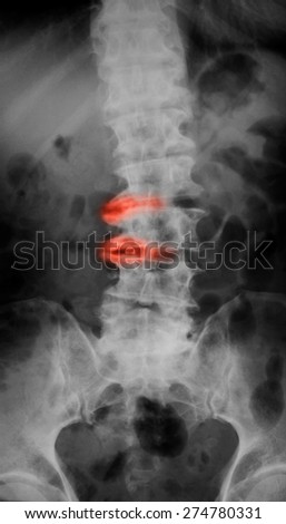 X-ray image of L-S spine, AP view, show ankylosing spondylitis lumbar