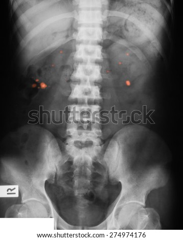 X-ray image of plain KUB (kidney, ureter, bladder), show  kidney stones.