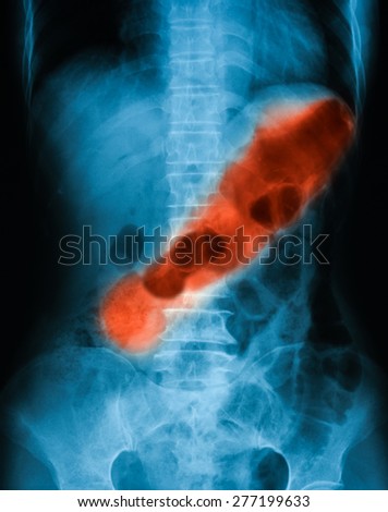X-ray image of abdomen, supine position. Showing stomach ulcer.