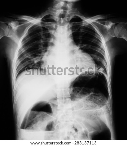 Chest x-ray image in a case of acute abdomen pain, upright view.