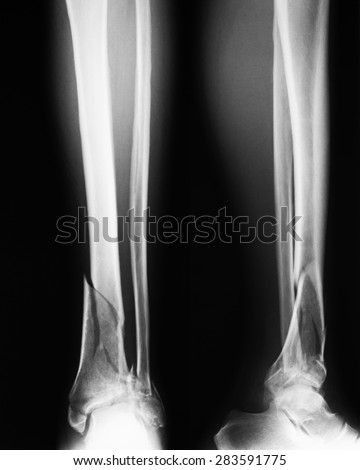 X-ray image of broken leg, AP and lateral view, Shows tibia and fibula fractures.