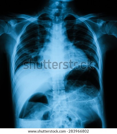 Chest x-ray image PA upright view, in case of acute abdomen pain.