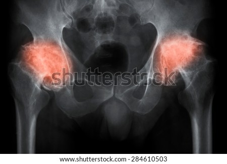 X-ray image of both hip, AP view, Showing osteoarthritis of the hips