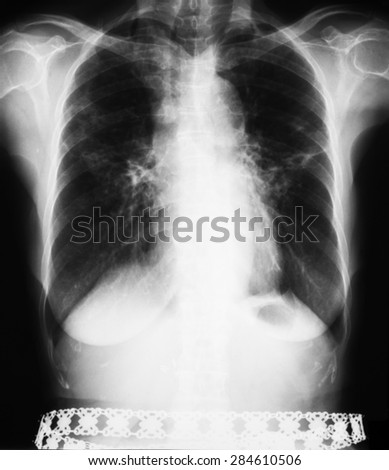 Chest X-ray image of a woman with a silver metal belt.