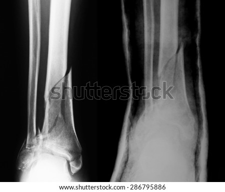 X-ray image of broken leg, AP view, comparison between before and after treatment by using plaster cast.