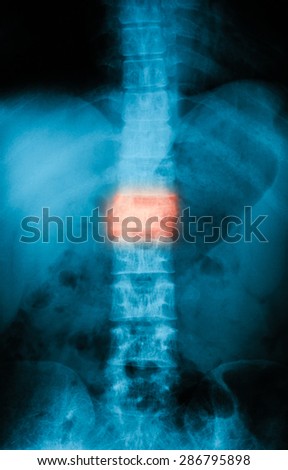 X-ray image of lumbar spine, AP view, Shows compression fracture of the first lumbar Spine