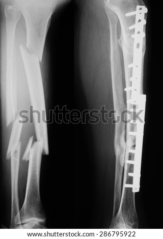 X-ray image of tibia and fibula fractures: comparison between before and after has been treated with plates and screws for 2 years