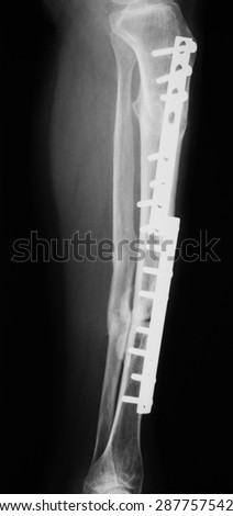 tibia and fibula fractures has been treated with plates and screws.