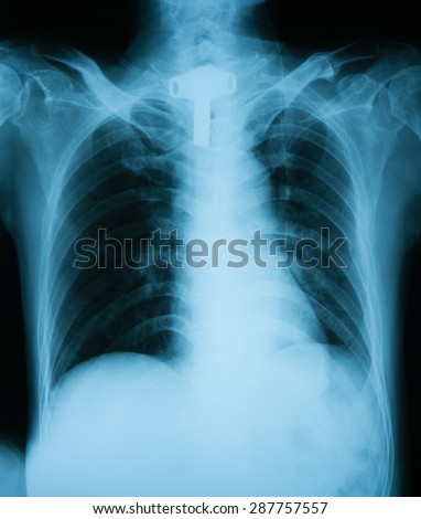 Chest X-ray image of a patient with tracheostomy tube