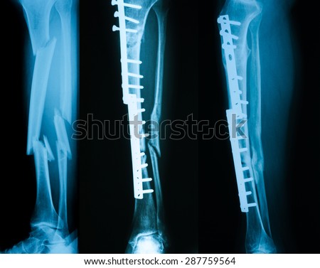 X-rays image of leg fracture, three times, from  left to right: 1 st, 2nd(5 month) and 3rd (2 years)