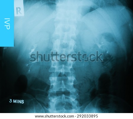 X-ray image of Intravenous pyelogram (IVP), 3 minute post injection of contrast media.