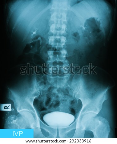 X-ray image of Intravenous pyelogram (IVP), 27minutes post injection of contrast media.