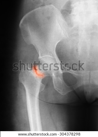 X-ray image of hip joint anteroposterior (AP) view, showing femoral neck fracture.