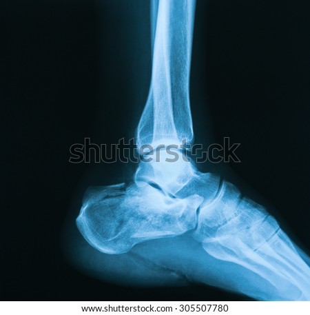 X-ray image of ankle, lateral view. Showing heel fracture.