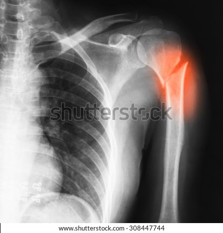 X-ray image of shoulder AP view. Showing  hemeral fracture.