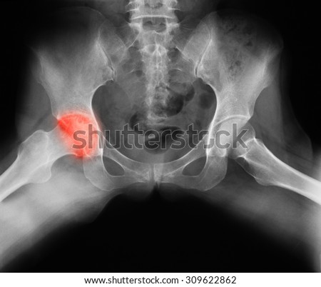 X-ray image of both hip, frog-leg view, showing hip osteoarthritis at the left side.