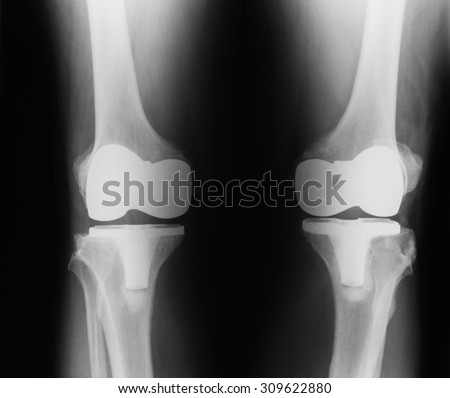 X-ray image of knee, both side AP view, showing total knee replacement.