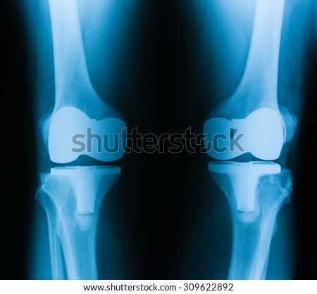 X-ray image of knee, both side AP view, showing total knee replacement.