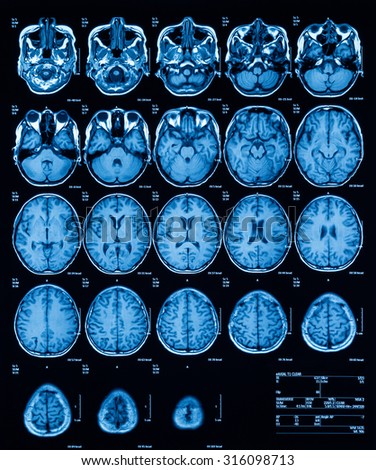 MRI (Magnetic resonance imaging) of the brain, transverse view, T2. (History: A 13 years old boy with fever and alteration of consciousness, was sent to rule out eosinophilic meningitis)