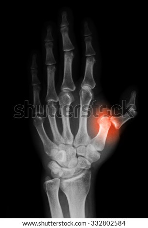 X-Ray Image Of Hand, Shows Fracture And Dislocation Of First Metacarpal ...