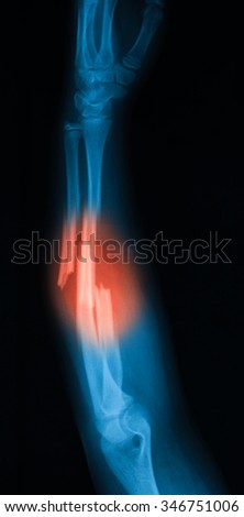 X-Ray Image Of Forearm, Lateral View. Show Ulna And Radius Fractures ...