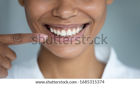 Close up african woman point finger at perfect straight hollywood white toothy smile. After whitening dental treatment procedure showing result, health stomatology dentistry service, oralcare concept