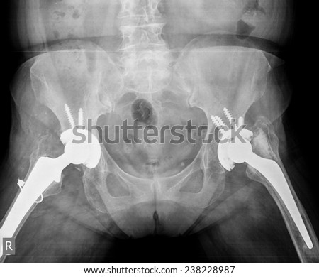 x-ray of hip prosthesis
